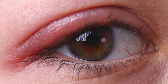 Prečo svrbenie očí: blefaritída