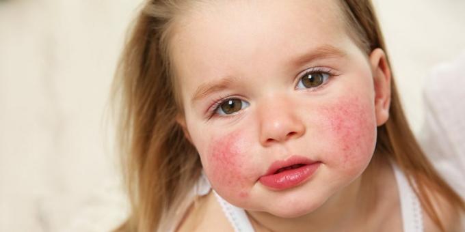 Vyrážka na tvári: potravinová alergia