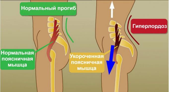 vpred rozkol: psoas