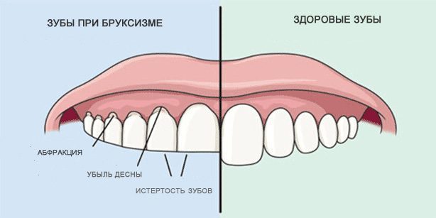 Škrípanie zubov: Zdravé zuby a zuby počas bruxizmom