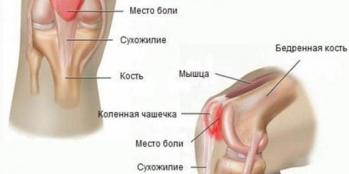 Prečo bolí kolená: Syndróm patellofemoral bolesti