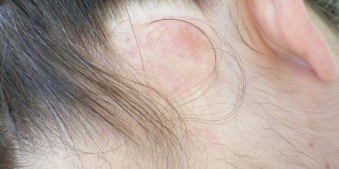 Prečo škriabe hlavu: zvyčajne sa objaví lymfómu u ľudí starších ako 50 rokov
