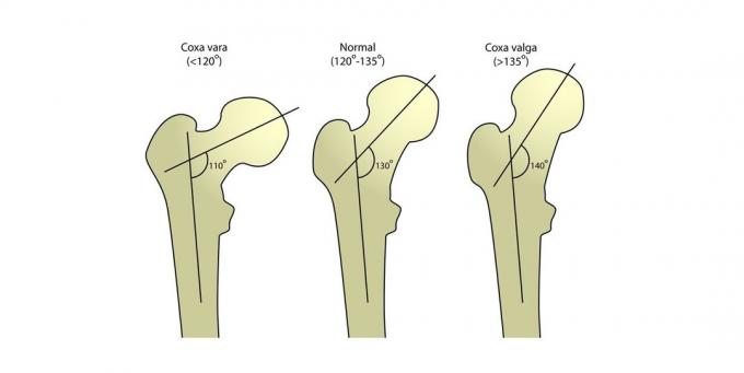 Krčku stehennej kosti: Angle