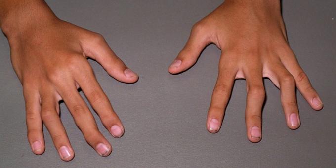 V neskorých štádiách reumatoidnou arthritis, sú možno deformácie a ohýbanie kĺbov