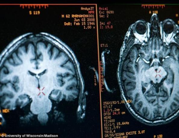Mozog Mathieu Ricard obraz získaný pomocou MRI