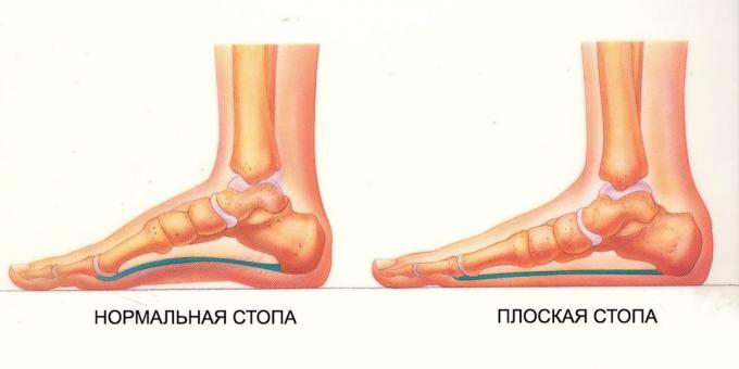 cvičenie pre ploché nohy: normálne a ploché nohy