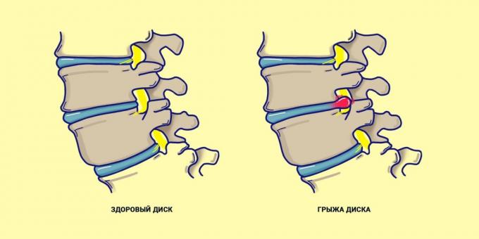 Prietrž chrbtice v porovnaní so zdravými chrbtom