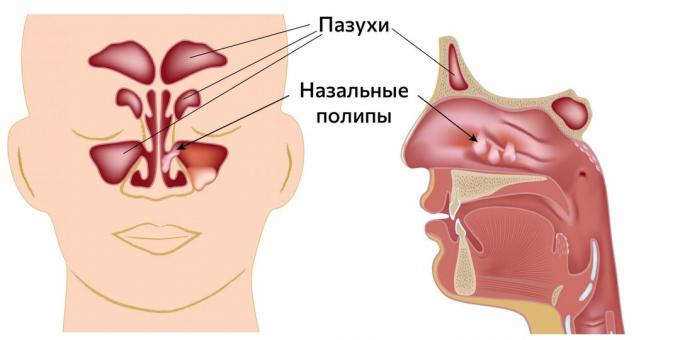 Polypy v nose