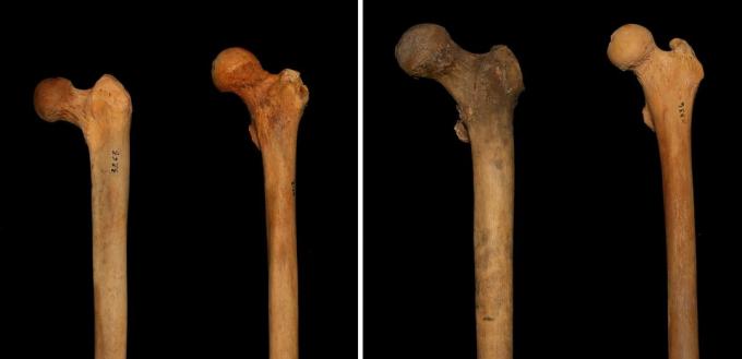 Krčok stehennej kosti