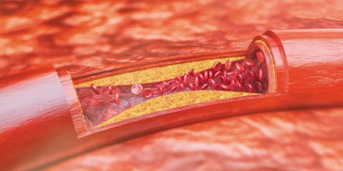 Cholesterol: aterosklerotické plaky