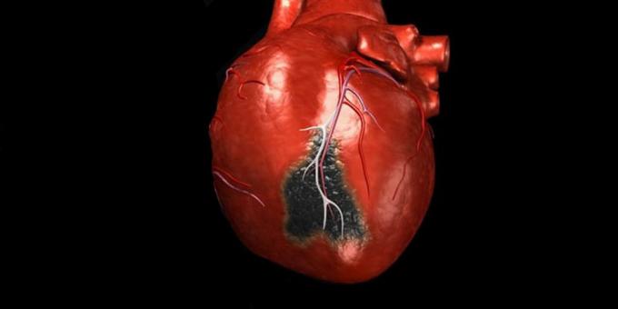 Príznaky srdcového infarktu, pre ktoré je potrebné volať sanitku