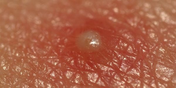 Ako sa zbaviť akné: Pustuly