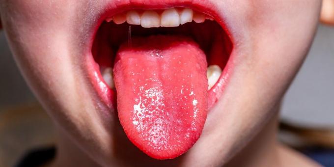 Príznaky šarlach: Jahodový jazyk