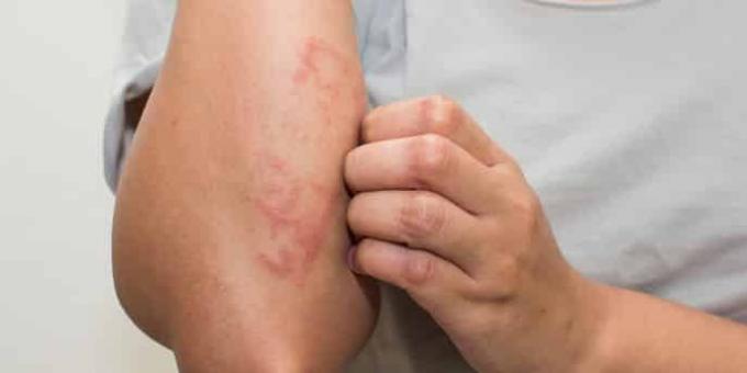 Overiť svoje príznaky s príznakmi alergie
