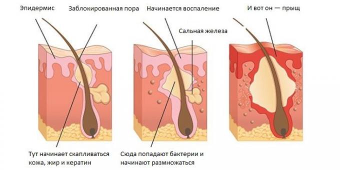 Ako sa zbaviť akné: Akné Príčiny
